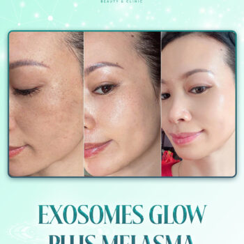 Flek, freckles, dan kulit kusam mulai munculWaktu, usia, dan polusi jadi penyebab utama kulit me