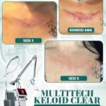 Multitech Keloid Clear, Hilangkan bekas luka dengan prinsip- AMAN, CEPAT, HASIL MAKSIMAL– Laser