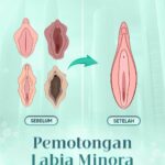Pemotongan labia minora di Sinclair- Aman- Tidak perlu istirahat- Lansung cantik setelah operasi